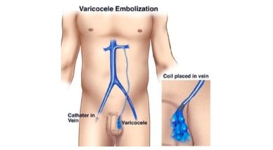 NO SCALPEL TREATMENT FOR VARICOCELE