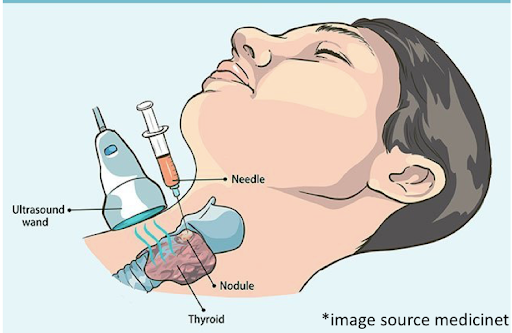 LYMPH NODE BIOPSY