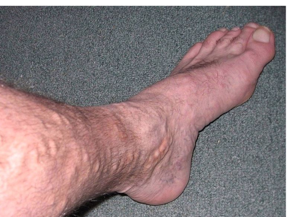 VARICOSE VEINS