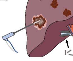 CHEMOEMBOLISATION AND ABLATION OF TUMORS